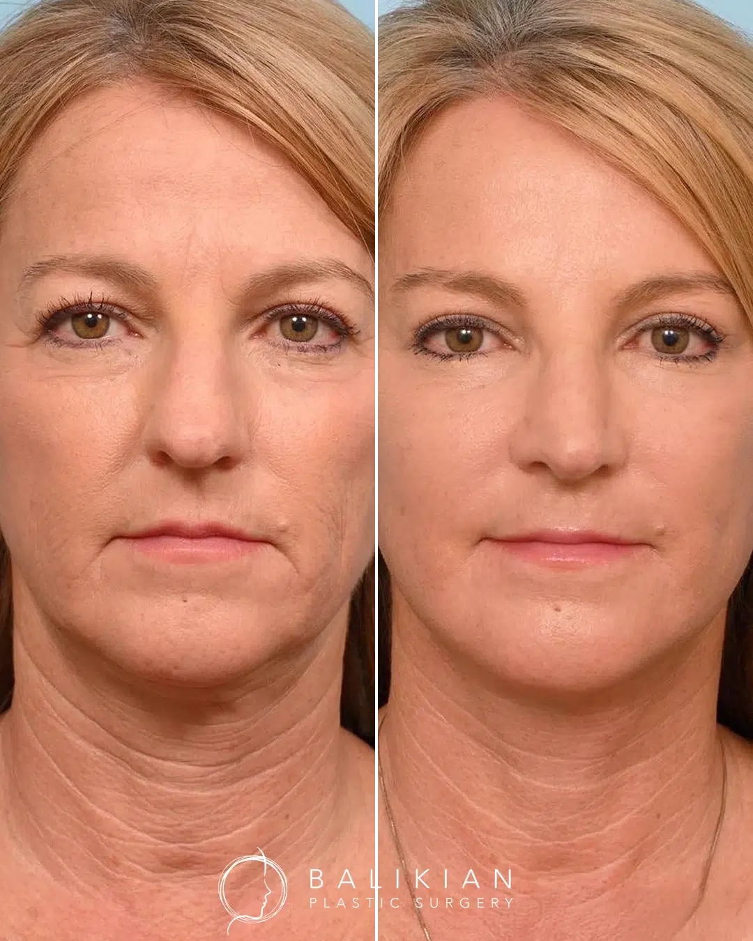 CO2 laser resurfacing before and after photo highlighting improved tone and reduced wrinkles on the lower face and neck for natural skin rejuvenation.