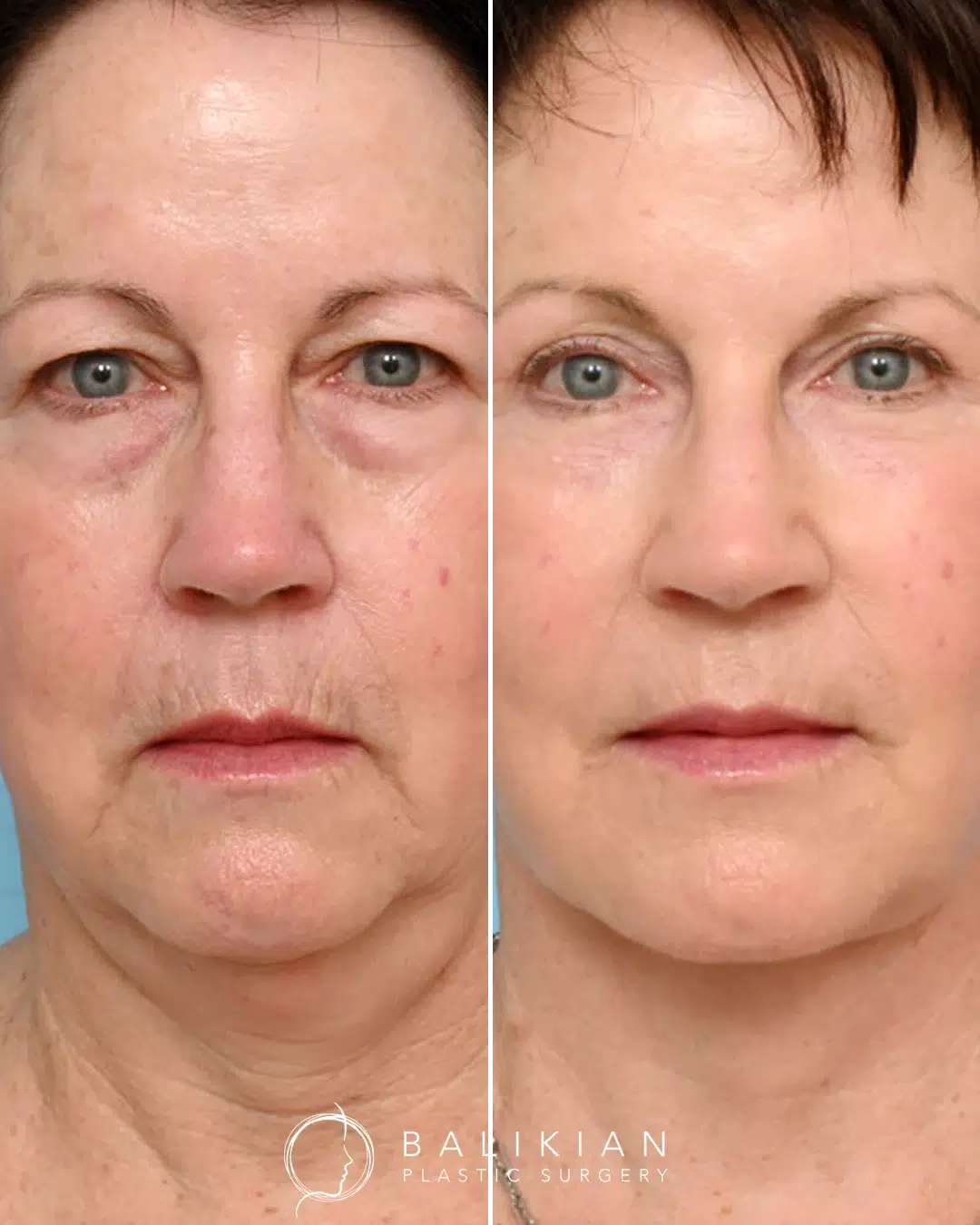 Fractional CO2 laser resurfacing before and after result showing tighter skin and diminished sun damage on the face for a refreshed, youthful look.