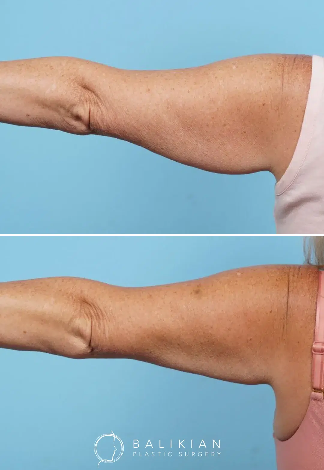 Right arm before and after CoolSculpting. The after image shows a slimmer upper arm with more toned appearance.