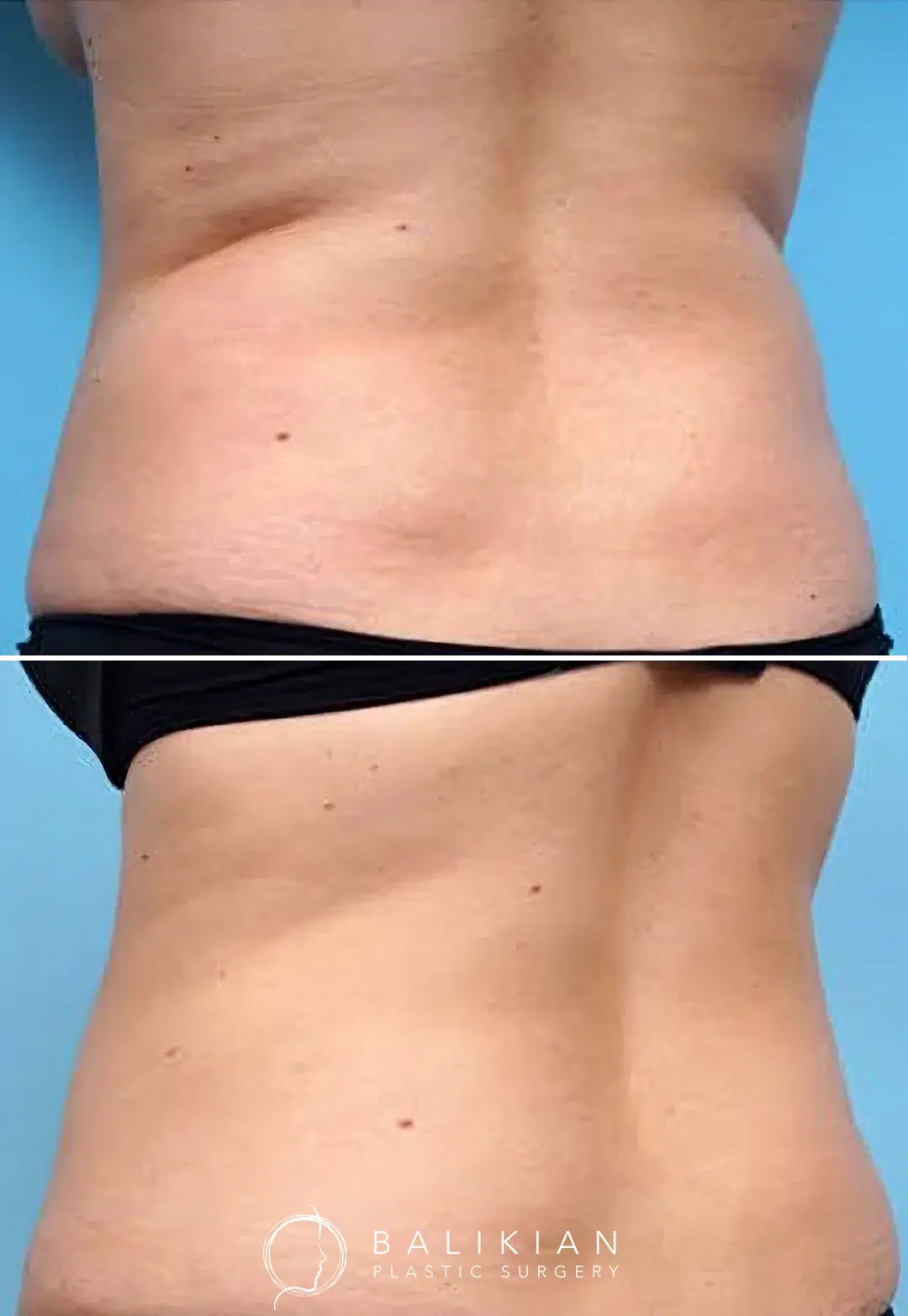 Before and after view of the mid-back area showing visible reduction in back fat following CoolSculpting treatment.