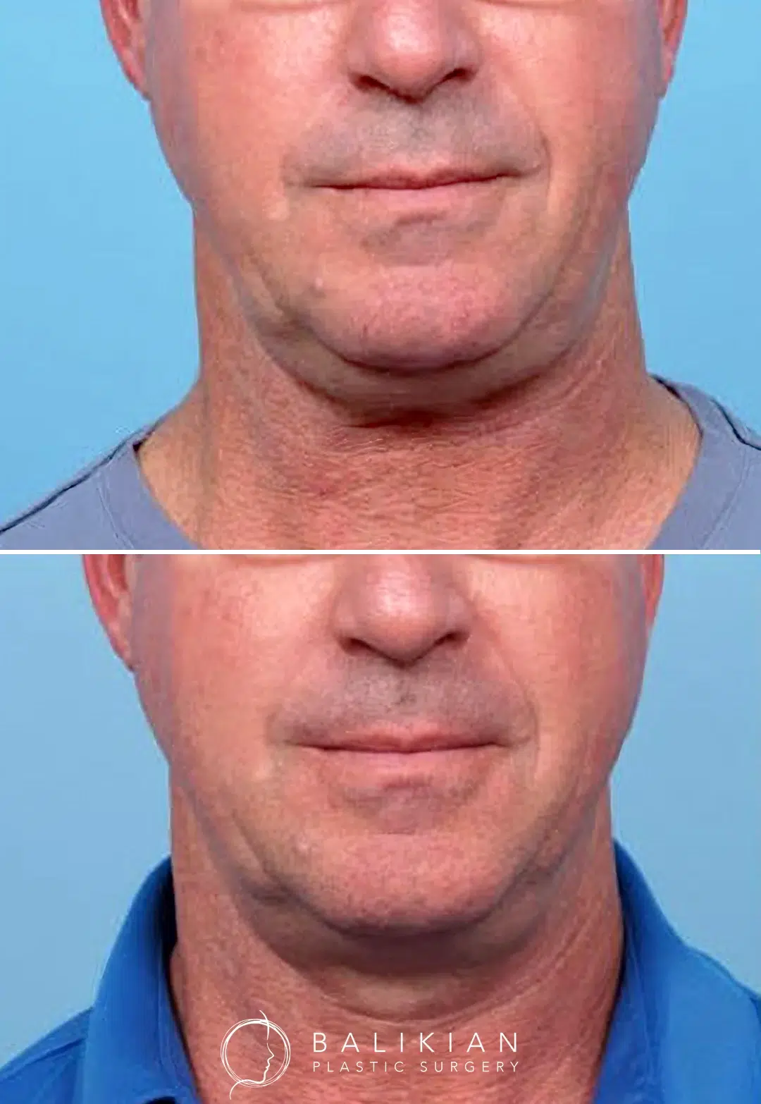 Frontal view of a male patient before and after CoolSculpting under the chin. The after photo shows improved chin definition and less visible neck fullness.