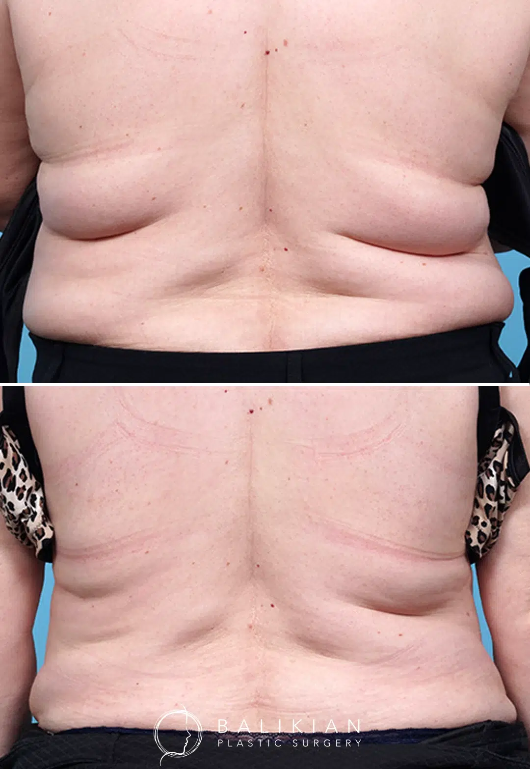 Before and after of the upper and mid-back following CoolSculpting. The after image shows a reduction in skin folds and improved back contour