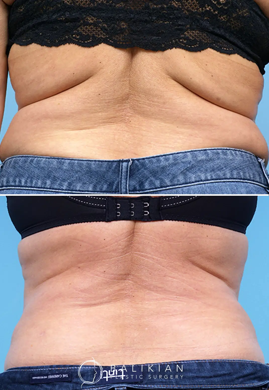 Before and after photo of a woman’s lower back and flanks following CoolSculpting treatment. Visible reduction in fat bulges and improved contour along the waistline