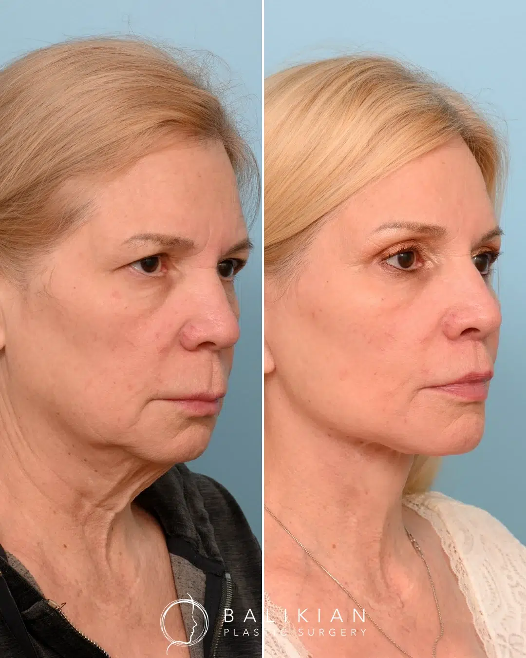 Facelift and neck lift before and after oblique view of an older woman with reduced jowls, lifted cheeks, and a smoother neckline.
