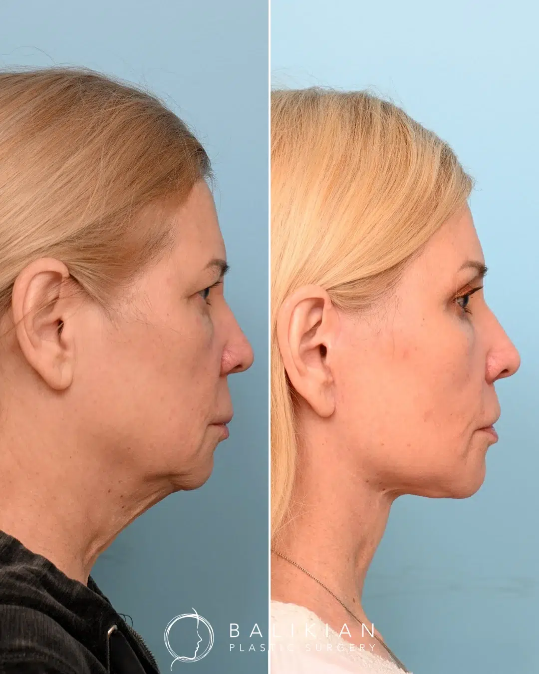 Facelift and neck lift before and after profile view showing significant tightening of loose skin under the chin and a more defined jawline.