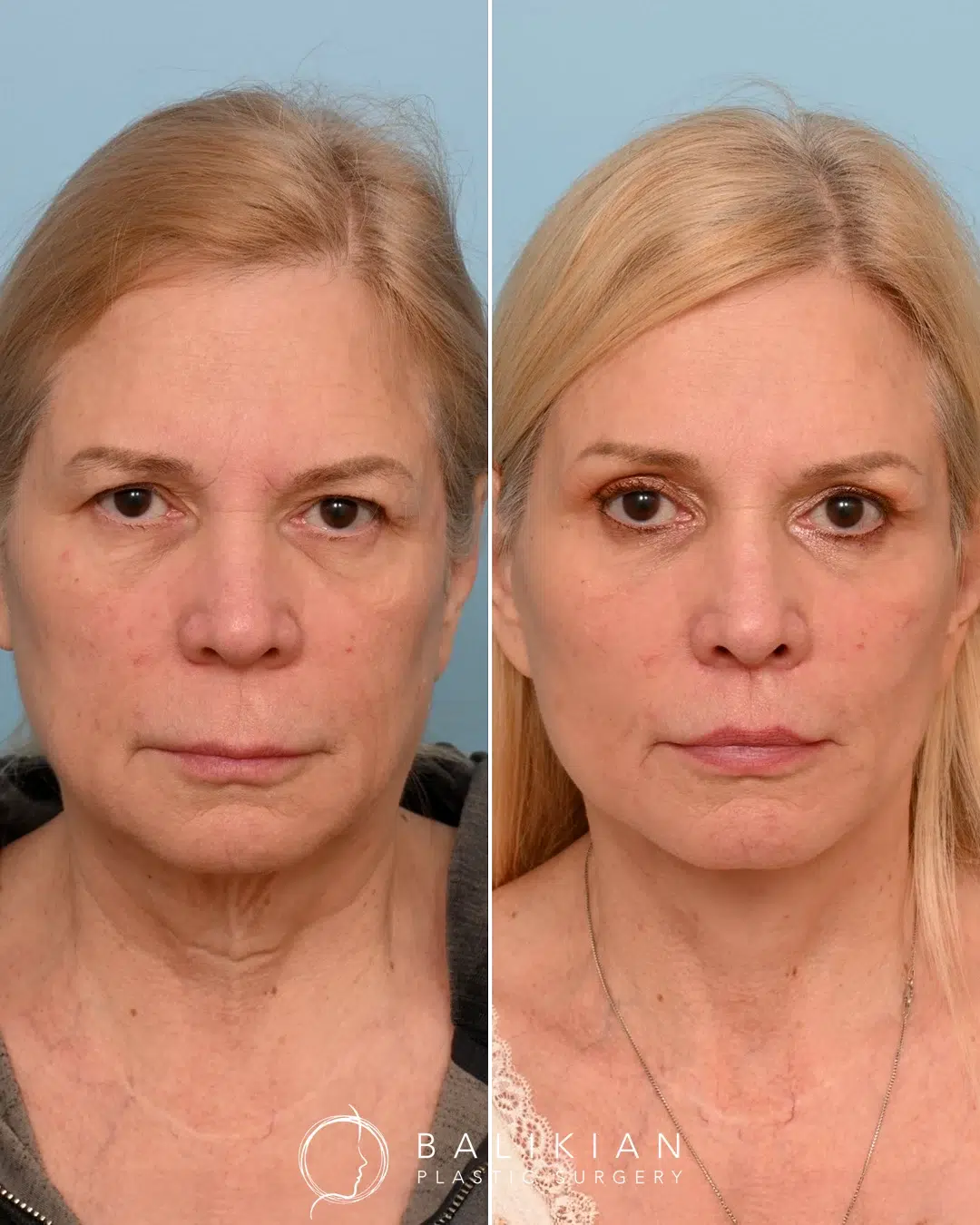 Facelift and neck lift before and after front view showing softened folds, firmer skin, and balanced facial features.