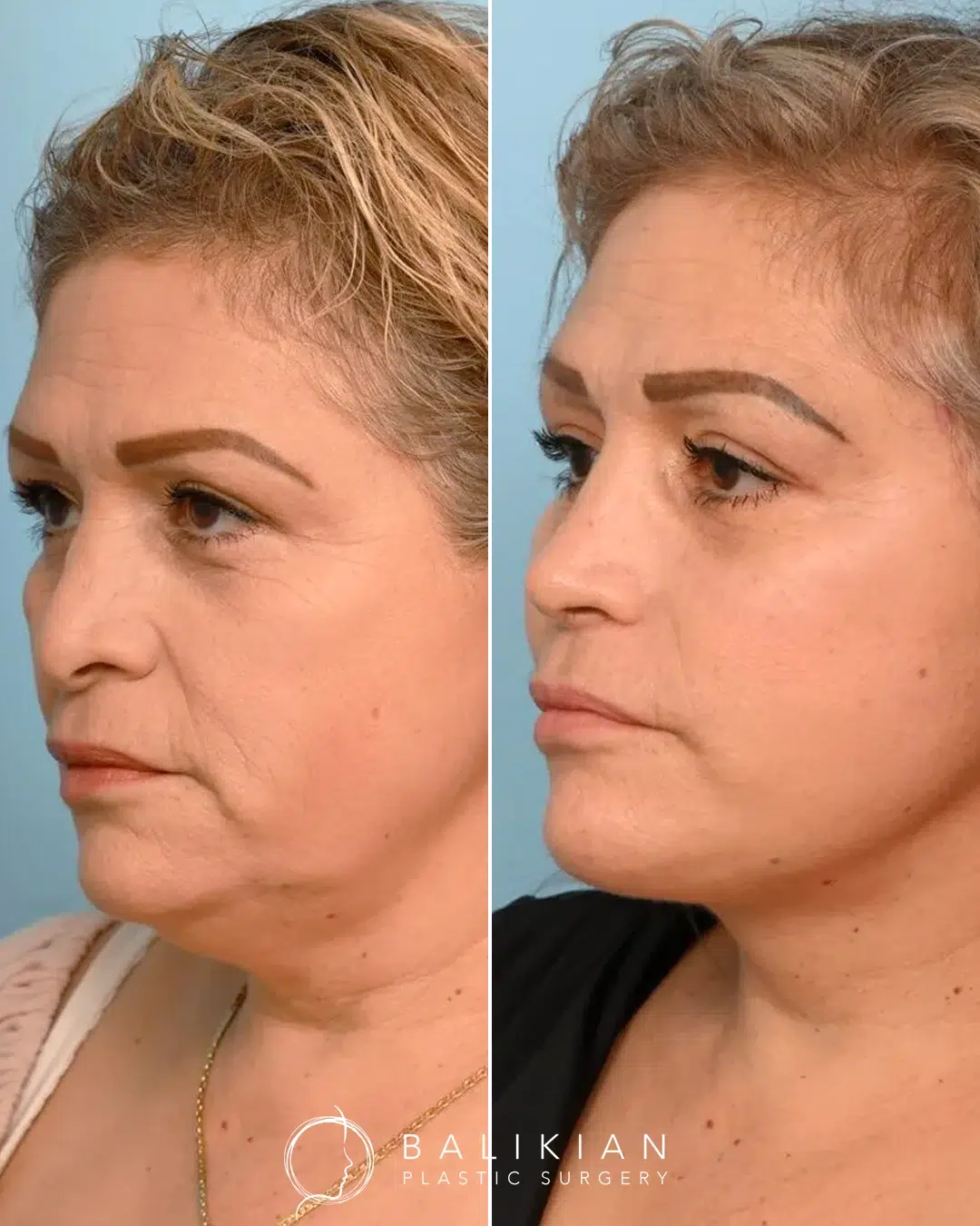 Before and after facelift angled view showing smoother lower face, lifted cheeks, and sharper jawline definition.