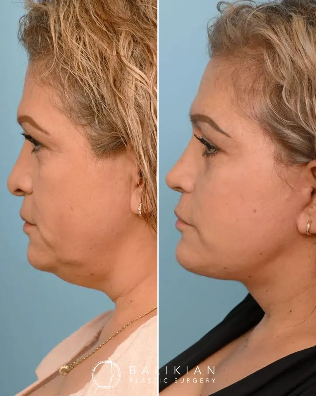 Before and after deep plane facelift of a woman in profile. Neck laxity and jowls improved, with a more defined chin and jawline.
