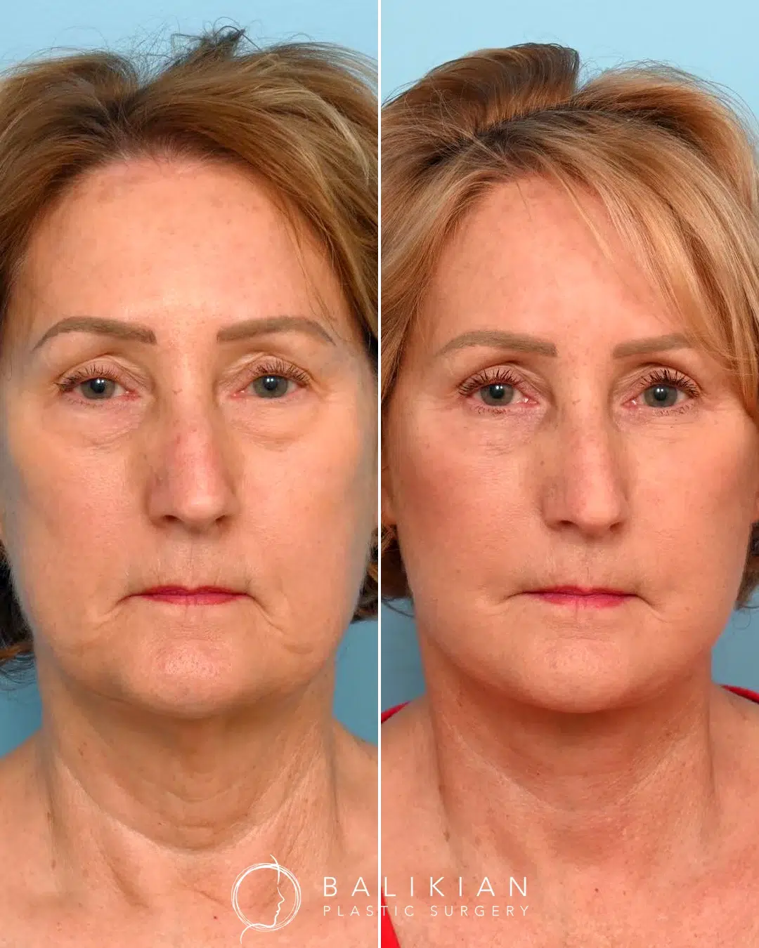 Facelift and neck lift before and after front view of a middle aged woman with smoother skin, reduced sagging, and a youthful look.