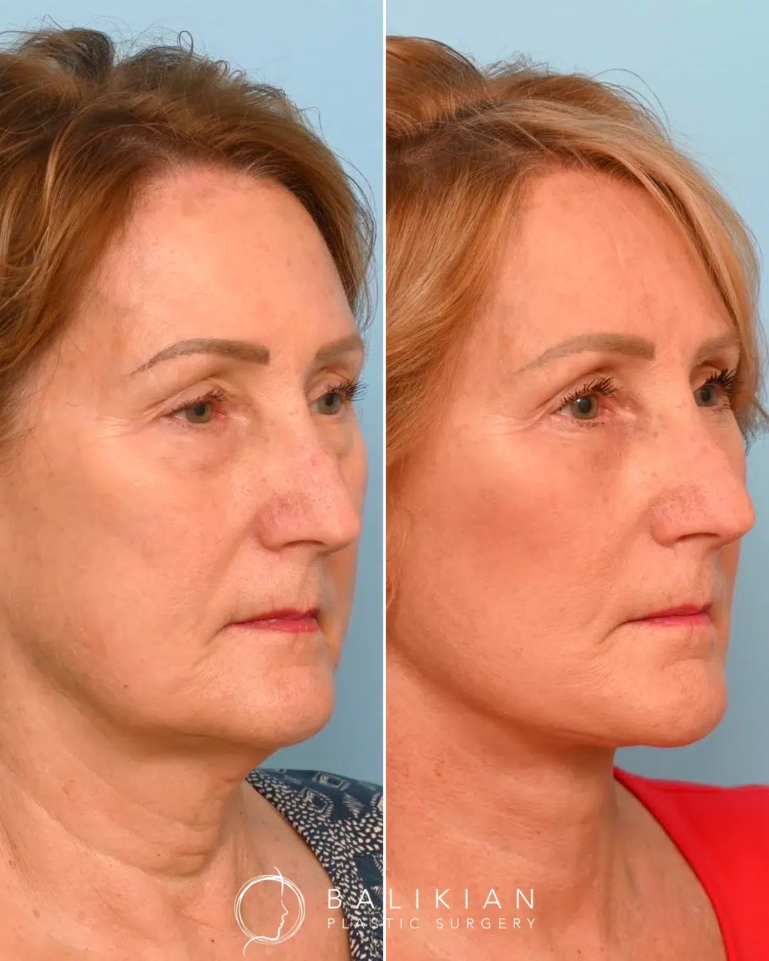Facelift and neck lift before and after oblique view showing a clean jawline, lifted cheeks, and tighter neckline.