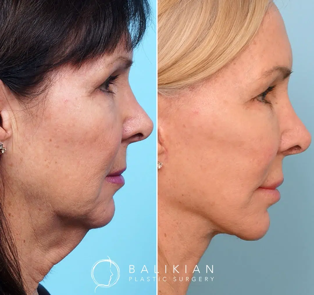 Profile view before and after facelift and neck lift, showing firm neckline and defined chin.