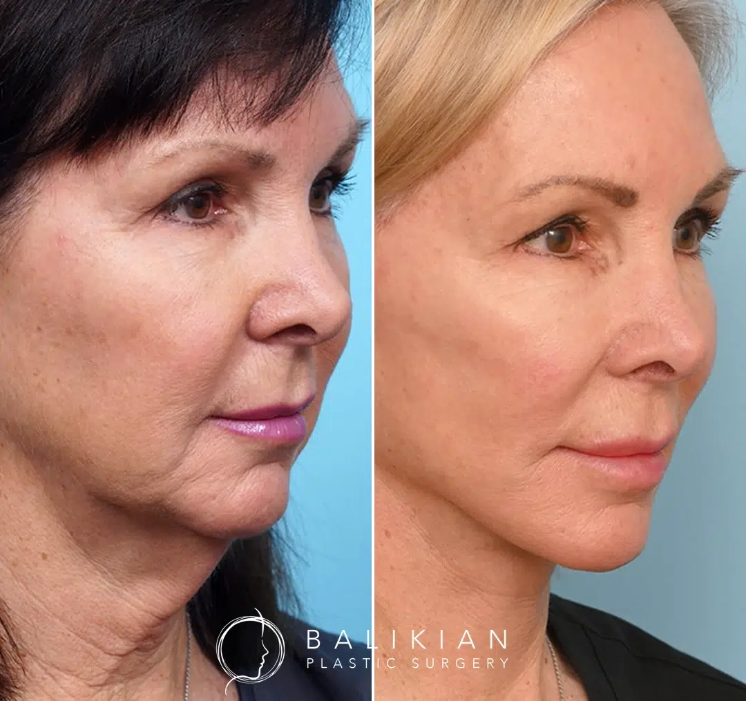 Angled view before and after facelift and neck lift, showing improved contour at jawline.