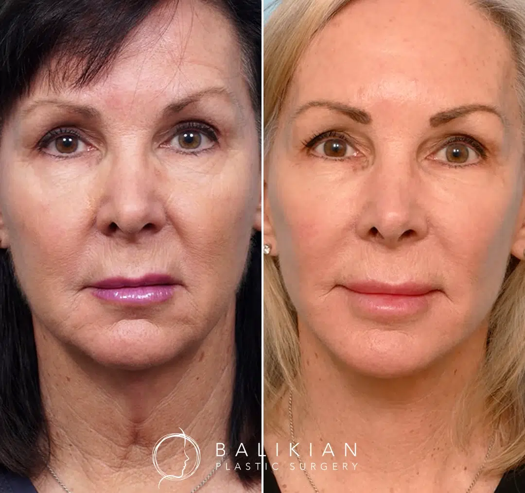 Frontal view before and after deep plane facelift and neck lift, showing lifted cheeks and smoother neck.