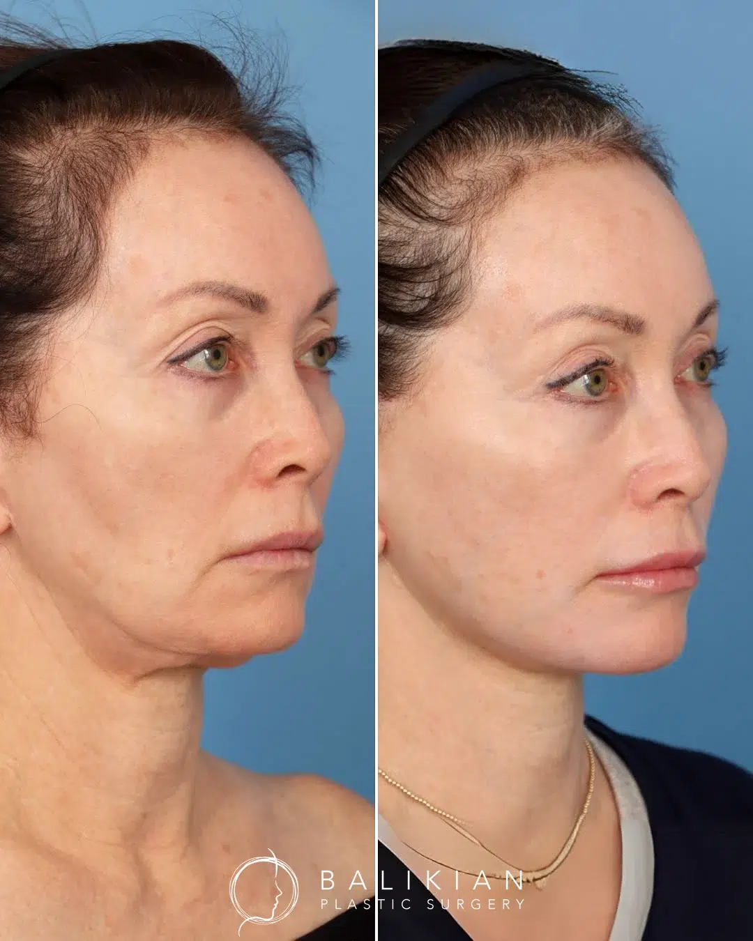 Three-quarter view before and after deep plane facelift and neck lift showing smoother neckline and defined jawline.
