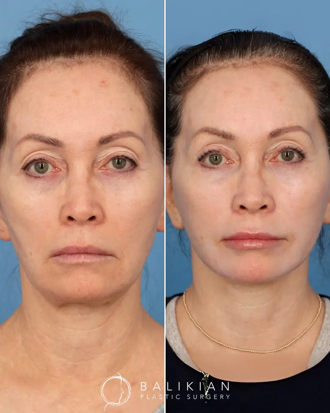 Front view before and after facelift and neck lift showing tighter lower face and rejuvenated appearance.