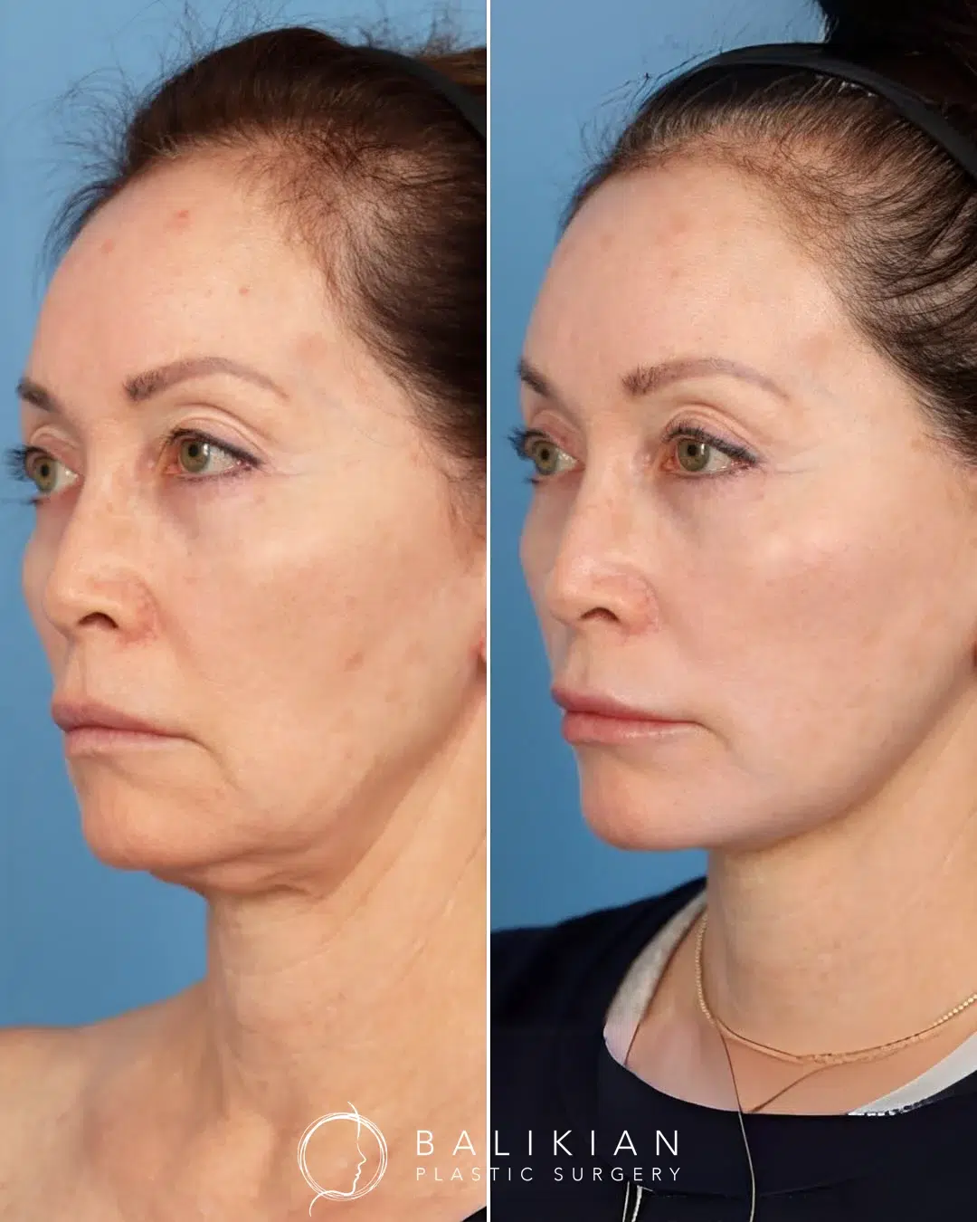 Three-quarter opposite view before and after facelift and neck lift highlighting natural lift and improved contour.