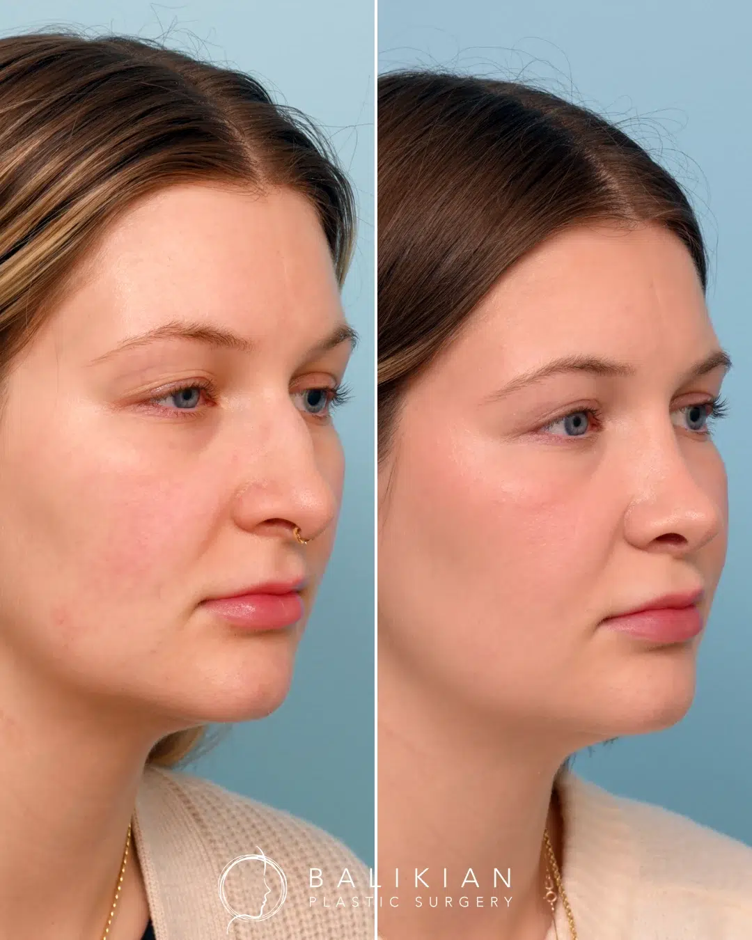 Side profile before rhinoplasty showing prominent dorsal hump on nasal bridge.