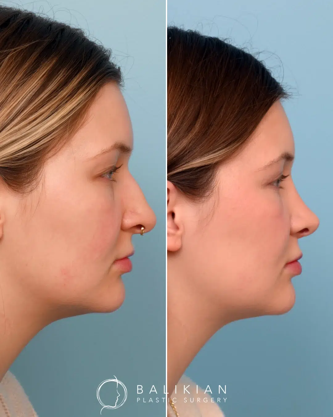Side profile after rhinoplasty with dorsal hump removed and straight nasal bridge.