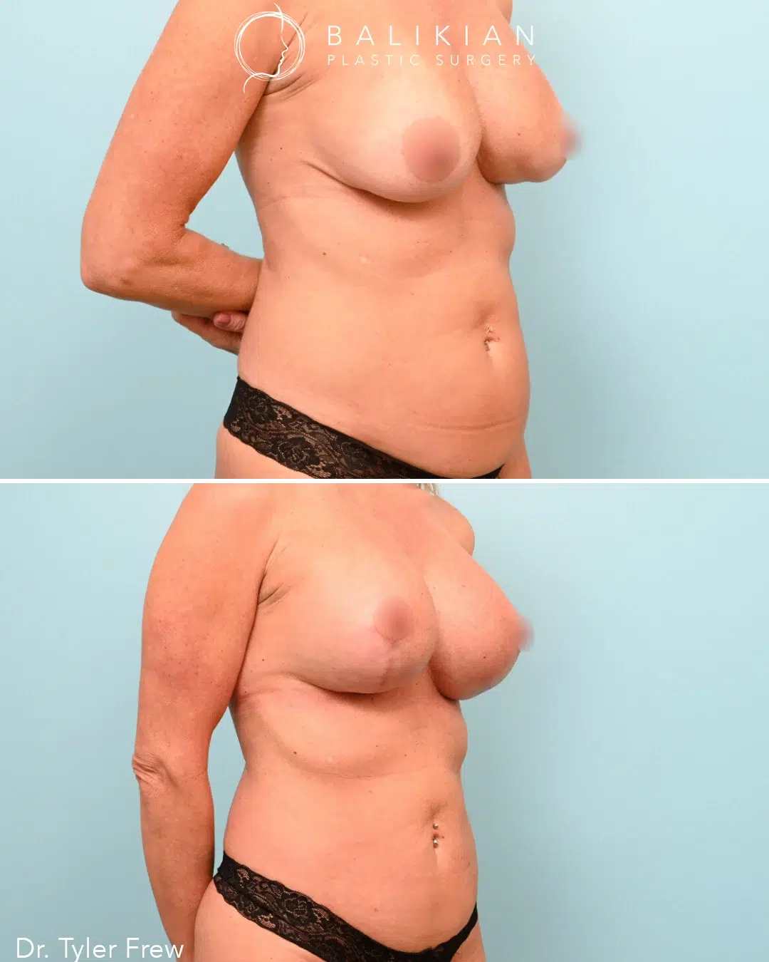 Side view of a female patient before and after Mommy Makeover highlighting improved breast volume and tightened abdominal contour.