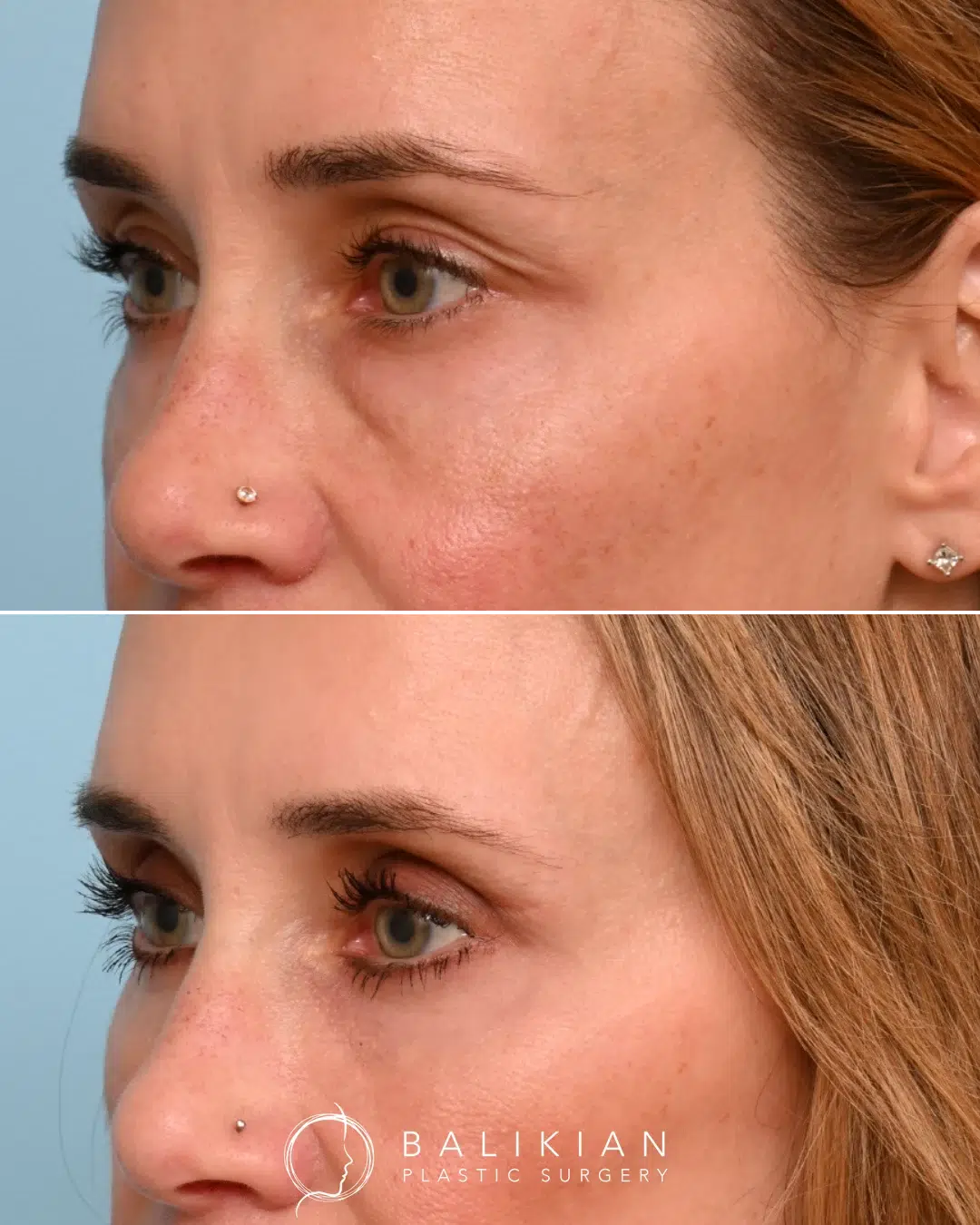 Lower eyelid blepharoplasty results, softening under-eye bags and restoring a rested, youthful appearance.