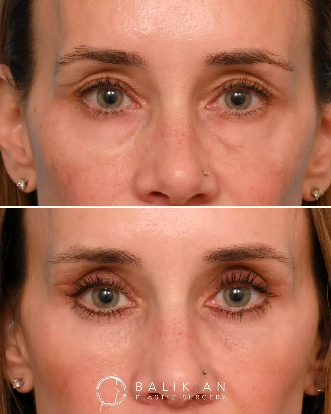 Upper and lower eyelid surgery results showing reduced hollowness and under-eye puffiness
