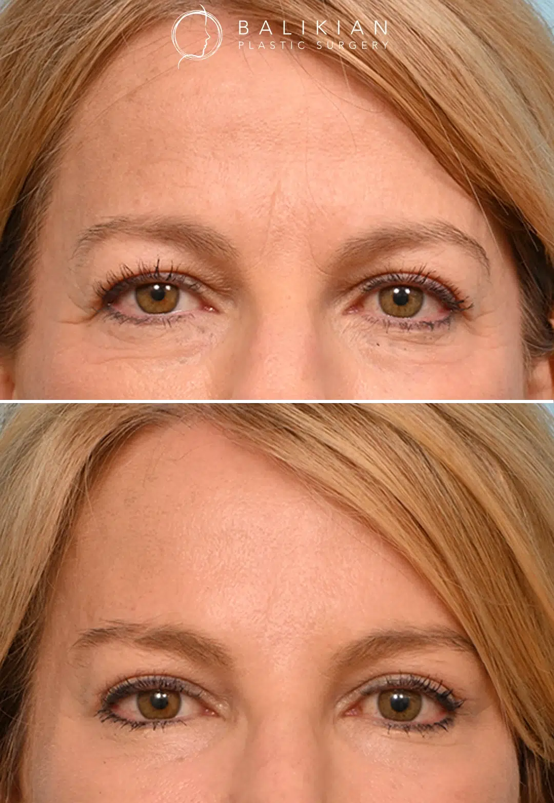 Before and after oblique view of a woman following brow lift procedure, with improved brow contour and reduced forehead creases.