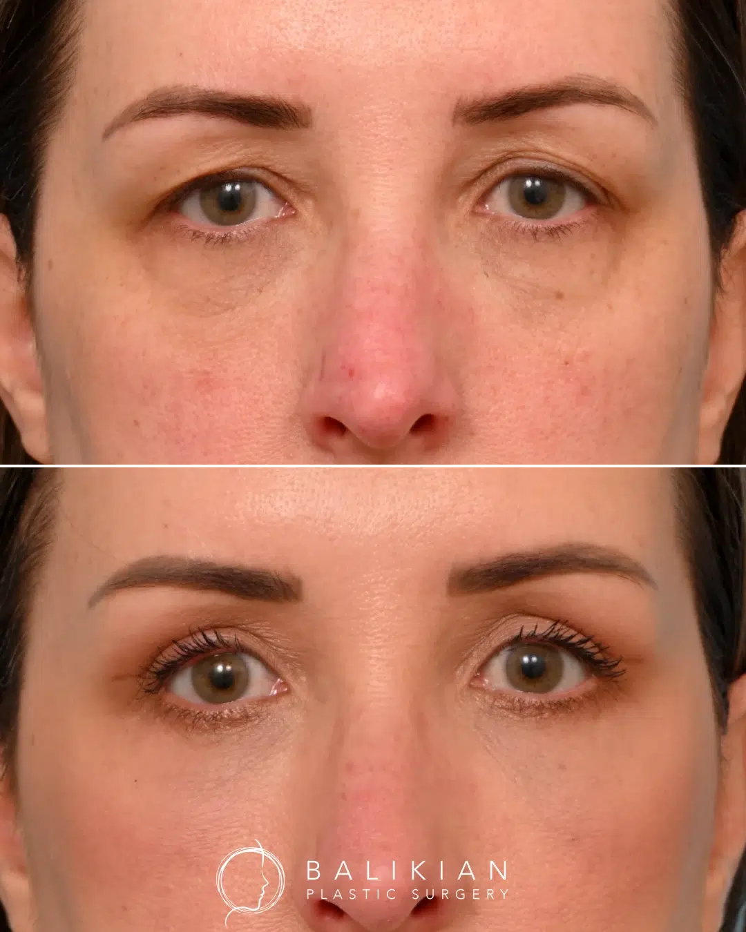 Upper eyelid surgery results with improved lid contour and youthful openness.