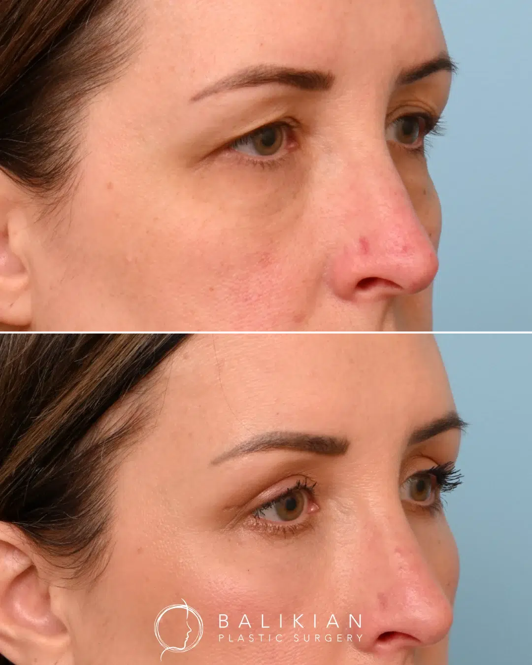 Before and after upper blepharoplasty reducing excess skin for a more vibrant gaze.