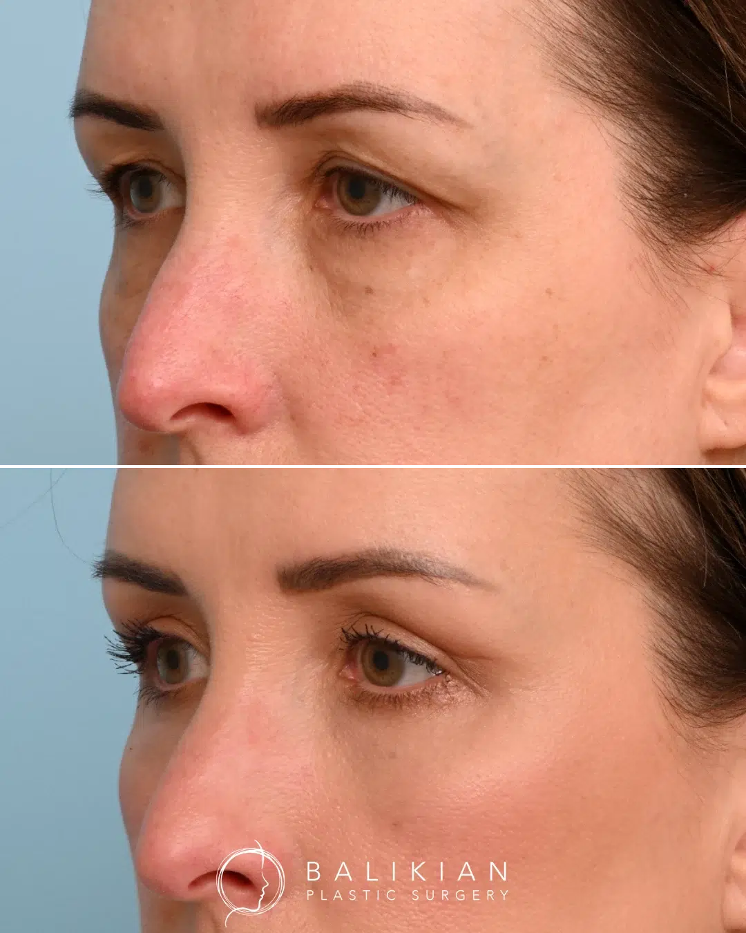 Upper eyelid lift results showing a smoother, more youthful eye appearance.