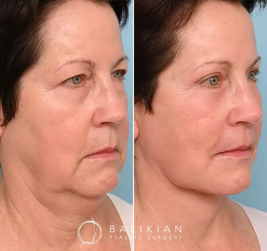 Angled view before and after facelift and neck lift, showing smoother skin and youthful facial balance.