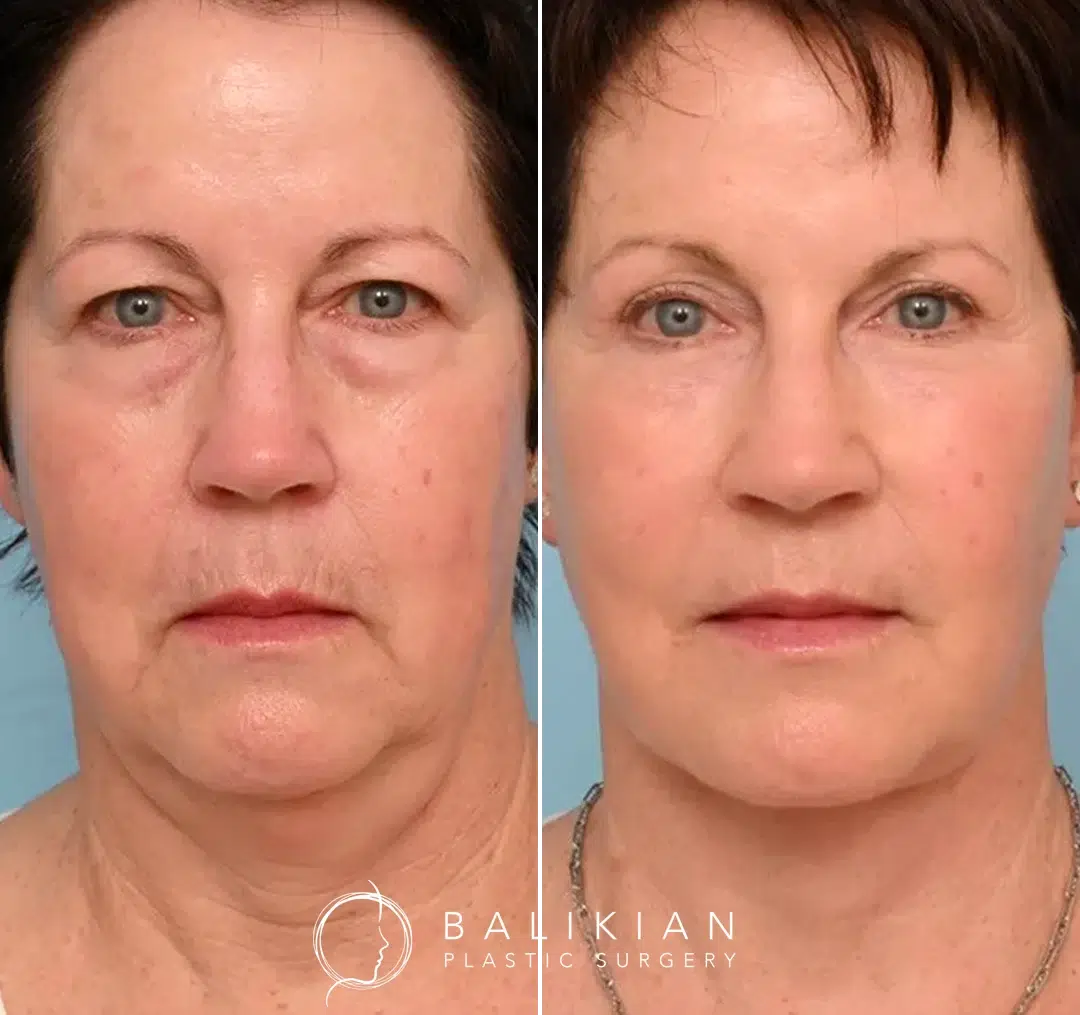 Frontal view before and after facelift and neck lift, showing reduced jowls and firmer jawline.
