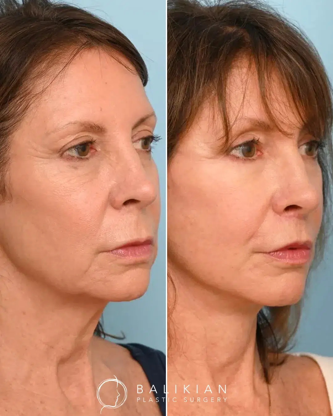 Before and after facelift at another angle highlighting improved cheek volume, neckline definition, and refreshed overall appearance.