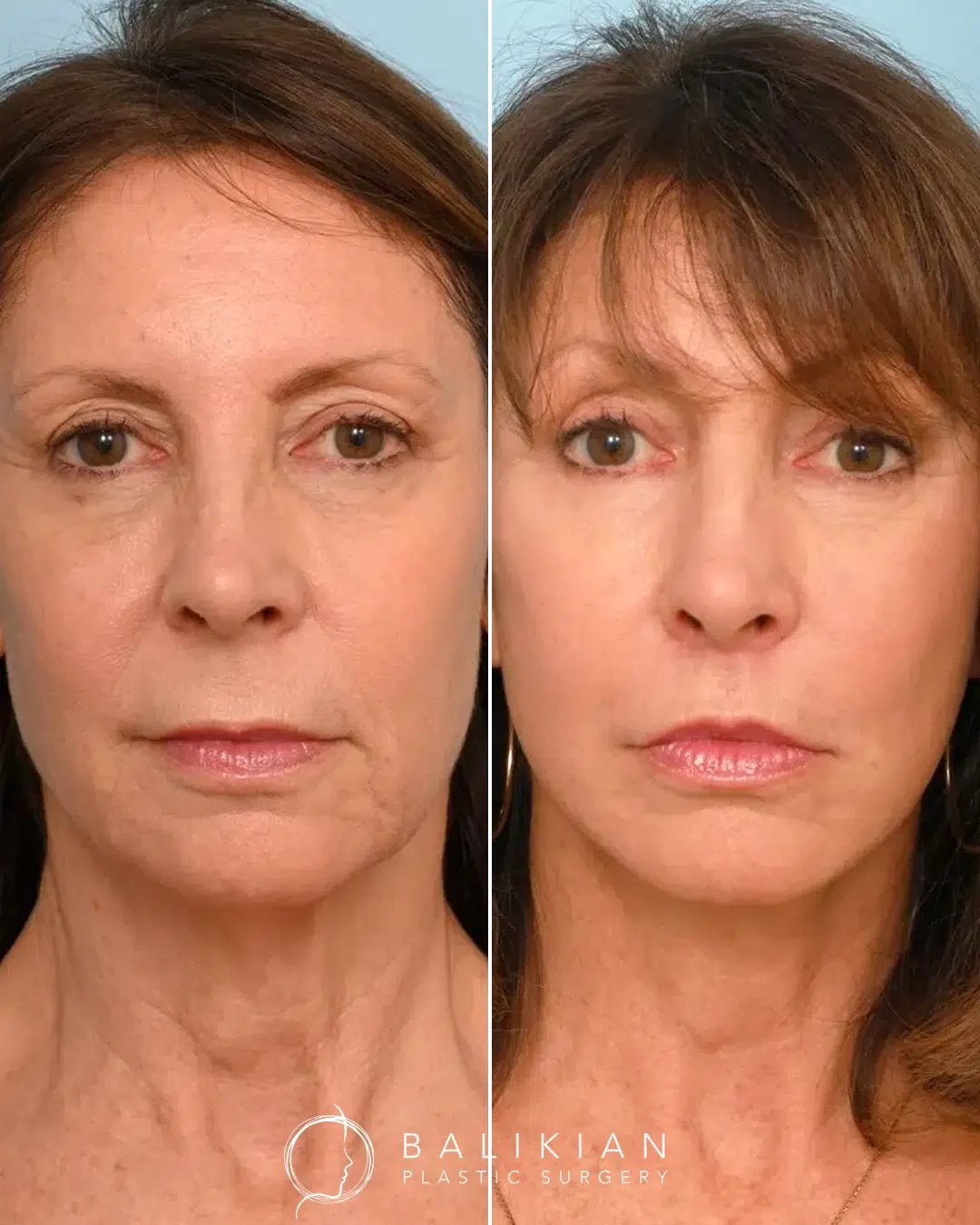 Before and after deep plane facelift of a woman. Improved neck banding, firmer skin, and youthful lower face contour.