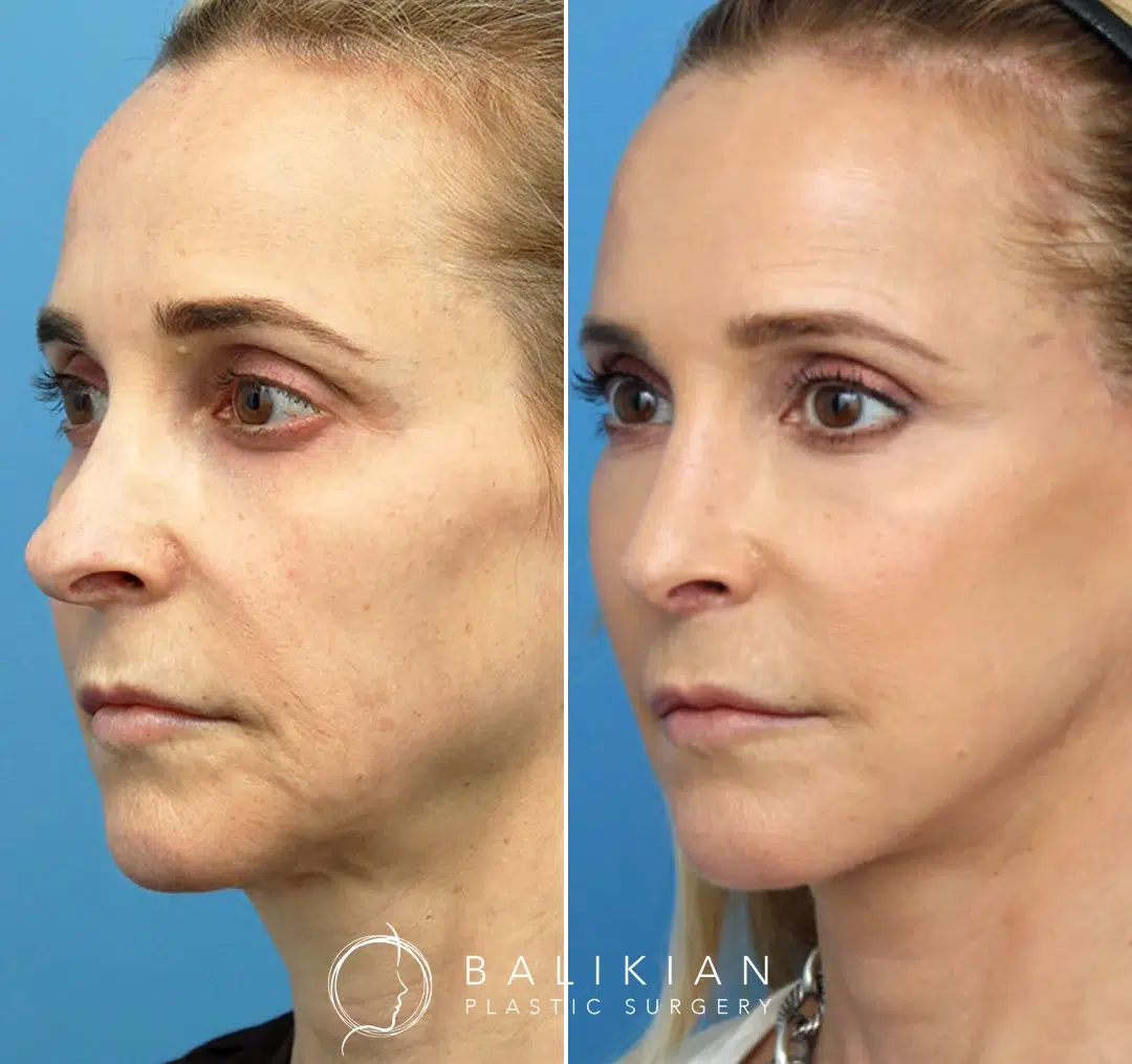 Angled view before and after facelift and neck lift, showing natural lift and defined jawline.