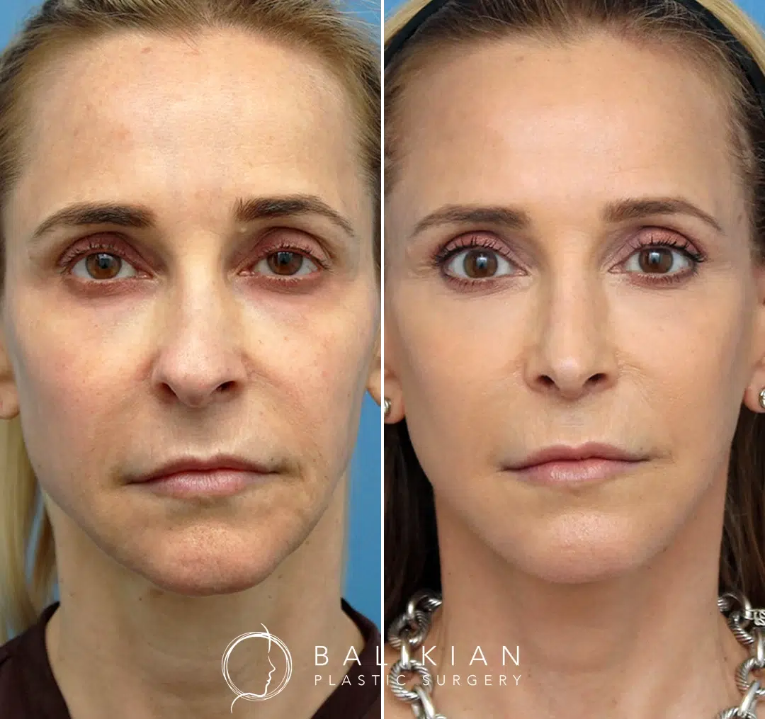 Frontal view before and after facelift and neck lift, showing smoother skin and refreshed eyes.