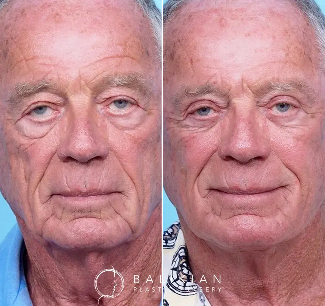 Front-facing before-and-after photos of an older man after facelift surgery, with smoother skin, lifted features, and a refreshed, more awake appearance.
