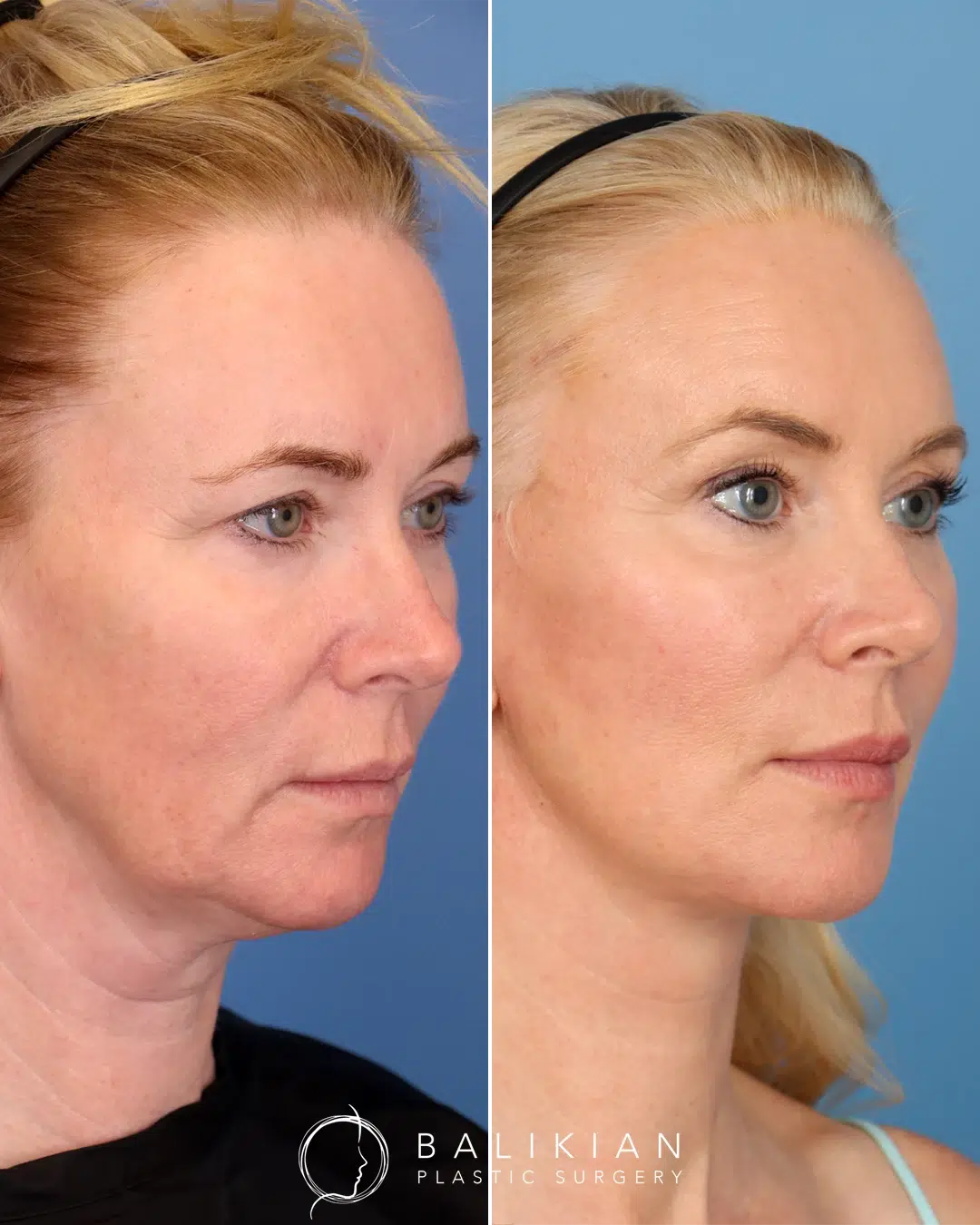Before and after facelift angled view showing improved jawline contour, tighter neckline, and natural cheek lift.