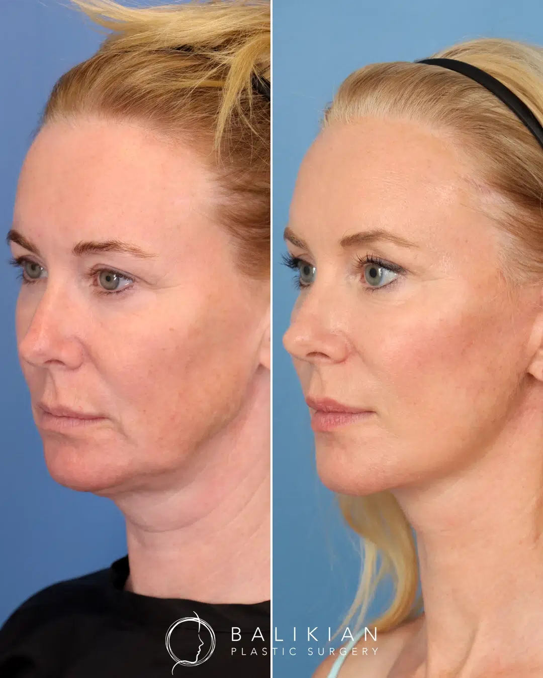 Before and after facelift angled view highlighting enhanced midface structure, reduced sagging around the jaw, and smoother neck profile.