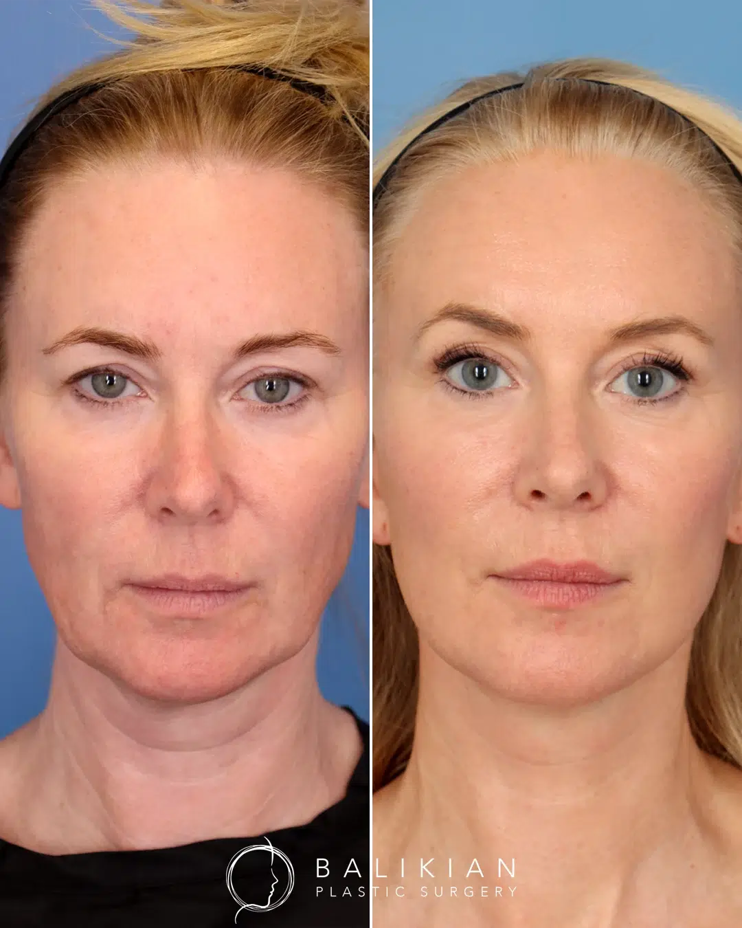 Before and after deep plane facelift of a woman. Noticeably smoother skin, lifted cheeks, refined jawline, and rejuvenated eyes with a more youthful overall appearance.
