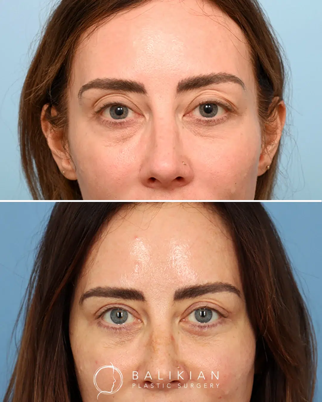 Before and after facial fat grafting restoring natural volume to cheeks and temples for a rejuvenated look.