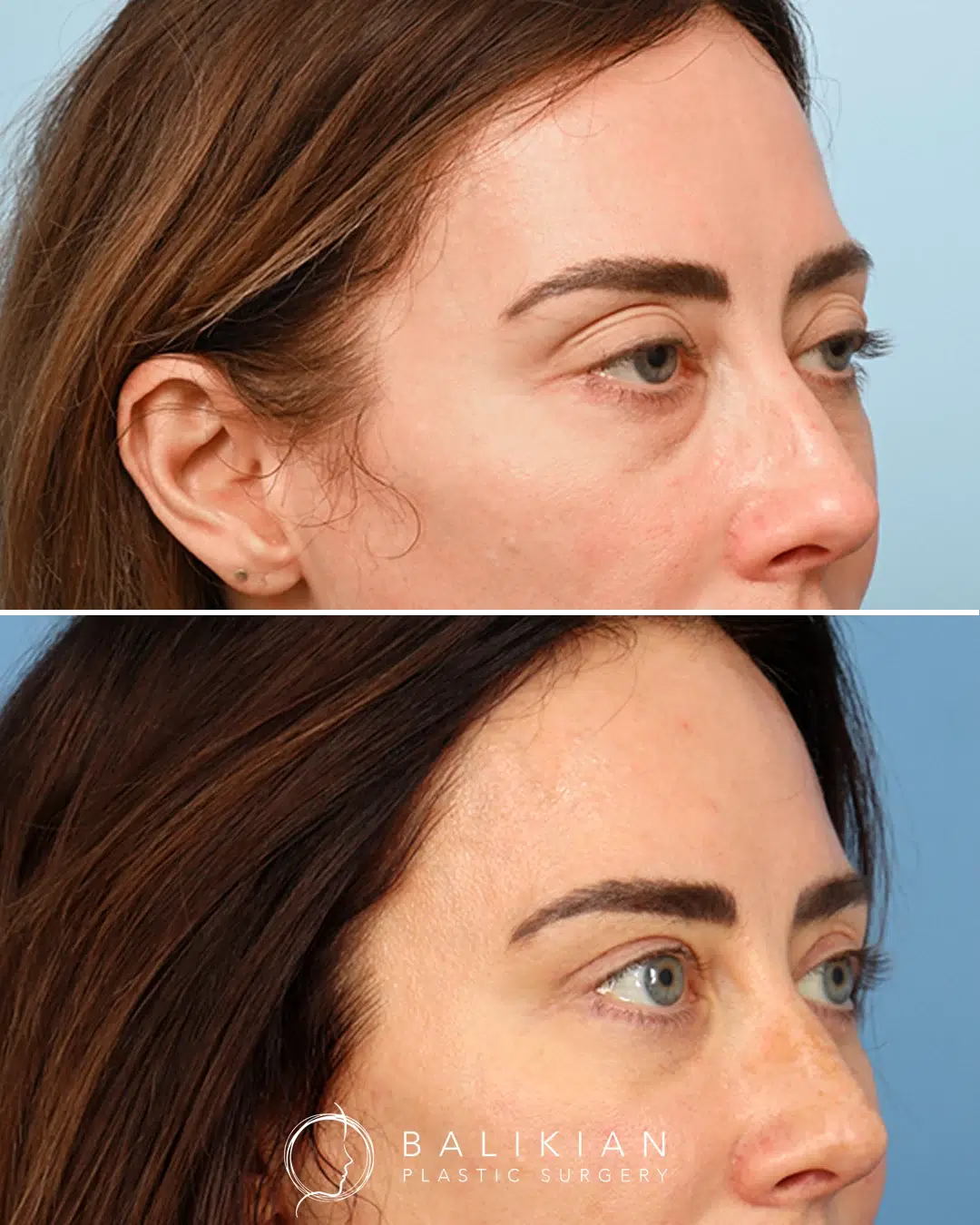 Side view before and after facial fat grafting showing lifted cheeks, smoother folds, and improved contour.