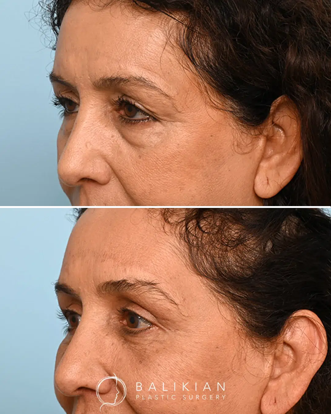 Before and after facial fat transfer improving midface fullness and under-eye volume for a youthful appearance.