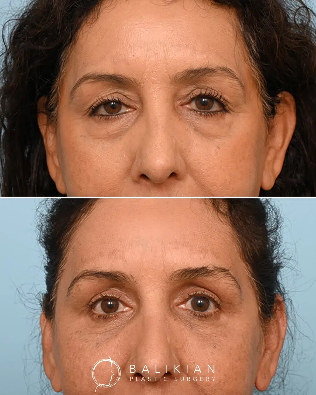 Side profile before and after facial fat transfer showing fuller cheeks, softer folds, and smoother skin texture.