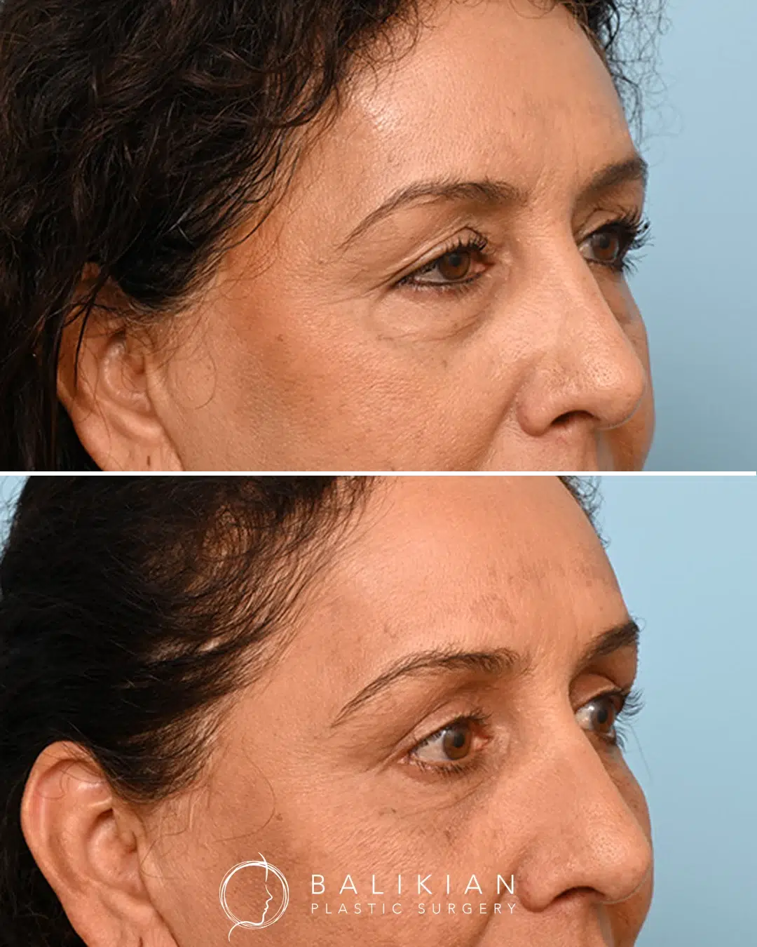 Angled view before and after facial fat transfer enhancing cheekbones and restoring balanced proportions.