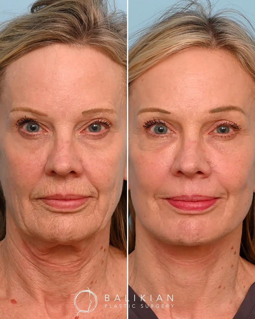 Before and after facial fat injections enhancing cheeks and under-eye area for a refreshed, natural look.
