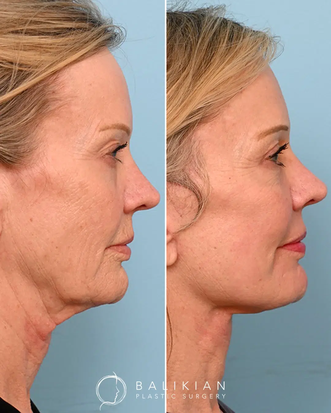 Side view before and after facial fat injections showing improved midface volume and facial balance.