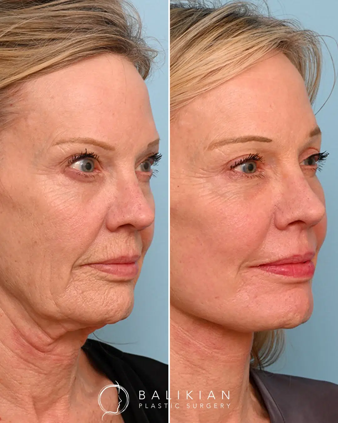 Angled view before and after facial fat injections highlighting fuller cheeks and smoother skin.