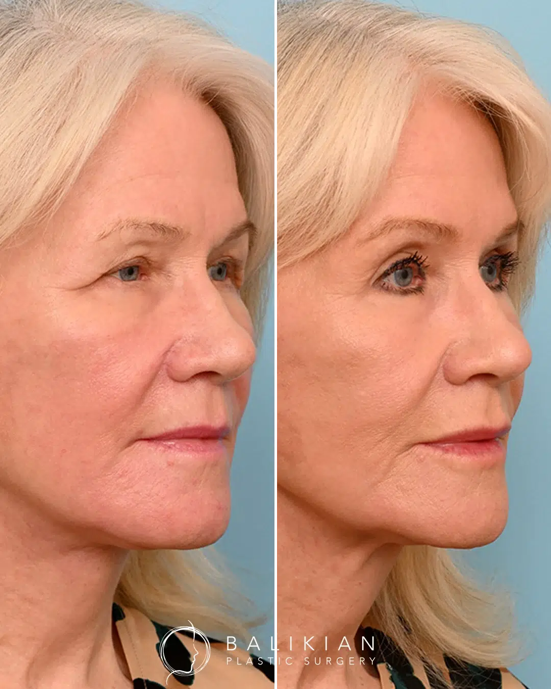 Before and after fat transfer to the face restoring volume, softening lines, and rejuvenating overall appearance.