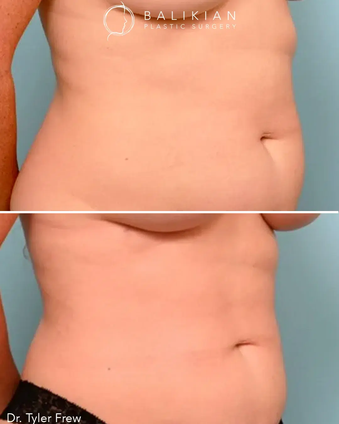 Female abdomen liposuction before and after, oblique view. Before: visible fat deposits along the lower abdomen and waistline. After: slimmer, smoother contour with reduced abdominal fullness.