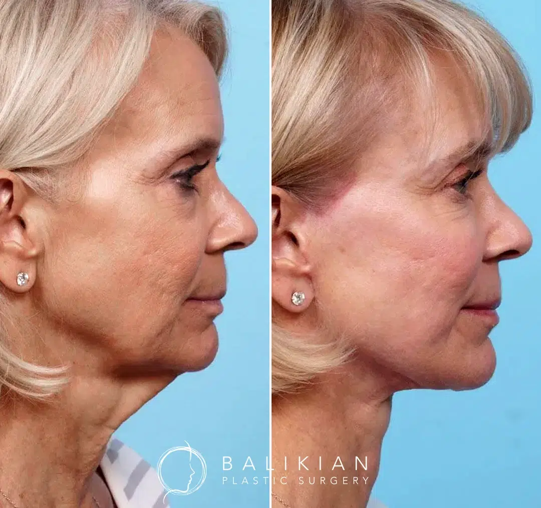 Side view before-and-after photos of a woman after facelift surgery, highlighting improved jawline definition, lifted cheeks, and a smoother neck profile.